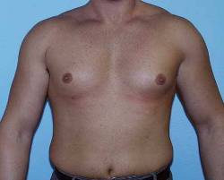 Before Image: Patient # 57972 - 