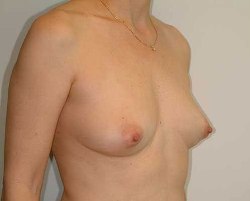 Before Image: Patient # 92893 - 