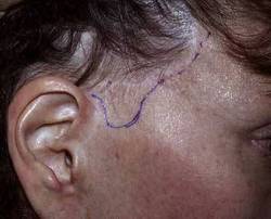 Before Image: Patient # 70553 - 
