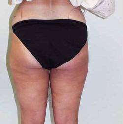 Before Image: Patient # 55841 - 