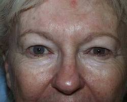 Before Image: Patient # 72961 - 