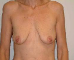 Before Image: Patient # 78770 - 