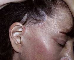 Before Image: Patient # 70553 - 