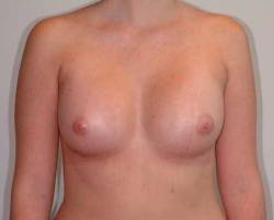 After Image: Patient # 66213 - 