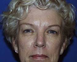 Before Image: Patient # 79508 - 