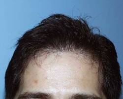 After Image: Patient # 74924 - 