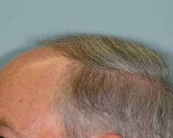 Before Image: Patient # 41082 - 