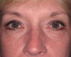Before Image: Patient # 24341 - 