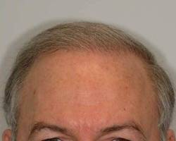 After Image: Patient # 41082 - 