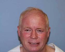 Before Image: Patient # 56242 - 