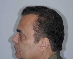 After Image: Patient # 84213 - 