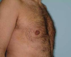 After Image: Patient # 61222 - 