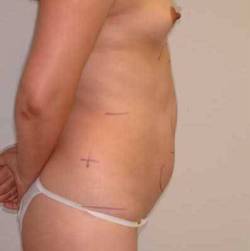 Before Image: Patient # 79803 - 