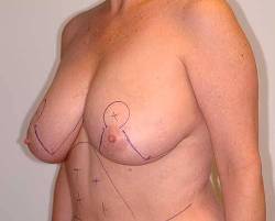 Before Image: Patient # 58331 - 