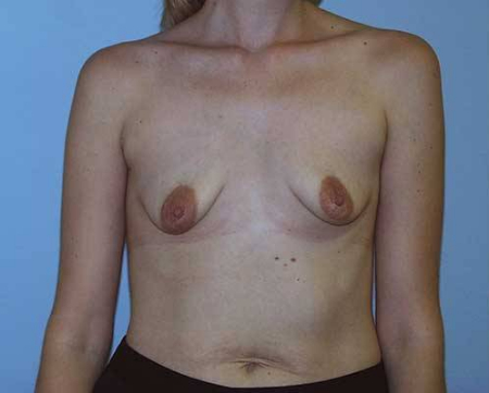 Before Image: Patient # 34852 - 