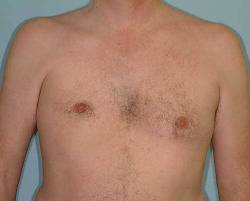 Before Image: Patient # 78514 - 