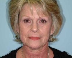 Before Image: Patient # 21982 - 