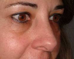 Before Image: Patient # 23251 - 
