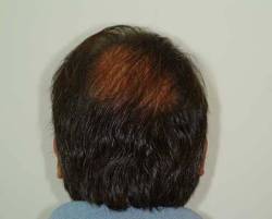 After Image: Patient # 94035 - 