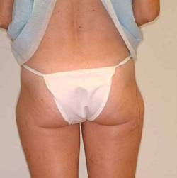 Before Image: Patient # 41163 - 