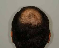 Before Image: Patient # 94035 - 