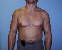 Before Image: Patient # 58006 - 