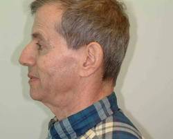 Before Image: Patient # 15207 - 