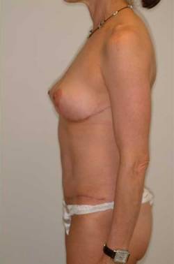 After Image: Patient # 69593 - 