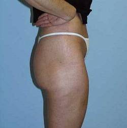 After Image: Patient # 37251 - 