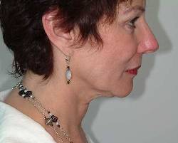 Before Image: Patient # 29216 - 