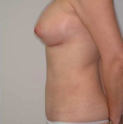 After Image: Patient # 24518 - 