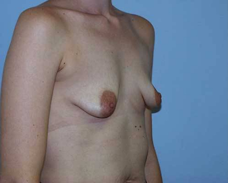 Before Image: Patient # 34852 - 