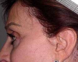 After Image: Patient # 99398 - 