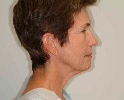 Before Image: Patient # 92609 - 