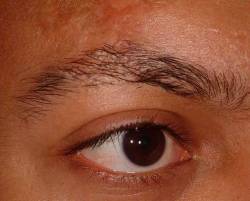 After Image: Patient # 54163 - 