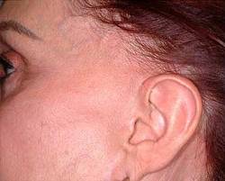 Before Image: Patient # 99398 - 