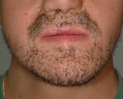 An image of a mans face that underwent a beard and mustache hair transplantation