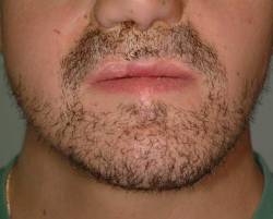 After Image: Patient # 28317 - 