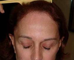 Before Image: Patient # 99398 - 