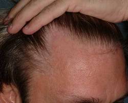 Before Image: Patient # 24703 - 