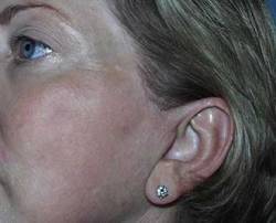 After Image: Patient # 51186 - 