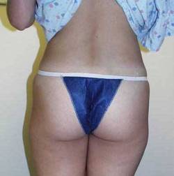 Before Image: Patient # 89230 - 
