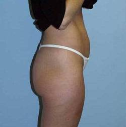Before Image: Patient # 37251 - 