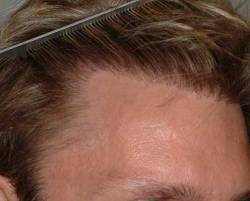 After Image: Patient # 24703 - 
