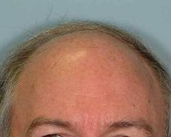 Before Image: Patient # 41082 - 