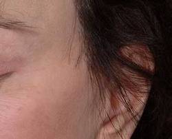 After Image: Patient # 70553 - 