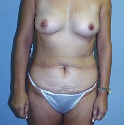Before Image: Patient # 64178 - 