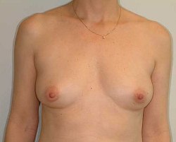 Before Image: Patient # 92893 - 