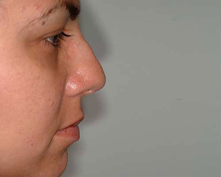Before Image: Patient # 78856 - 
