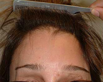 Before Image: Patient # 79193 - front